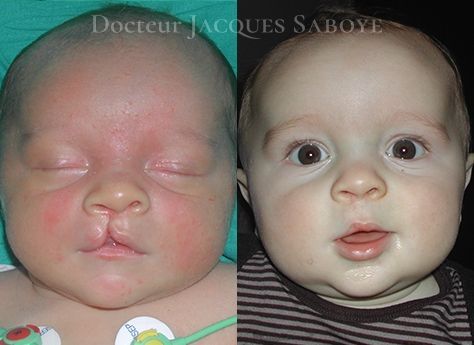 La Chirurgie Plastique Des Fentes Labiales Toulouse Dr J Saboye